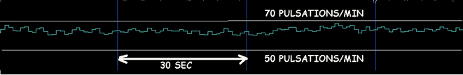 HRV 